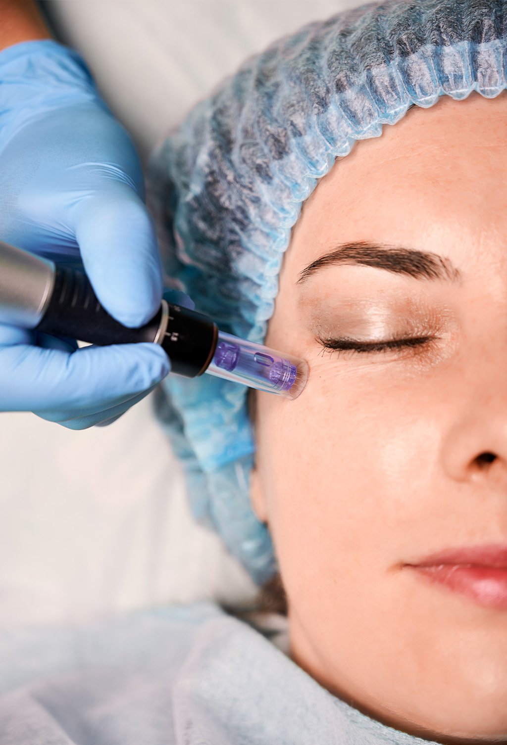 MicroNeedling